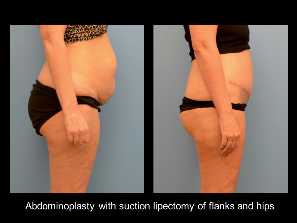 Liposuction - Abdomen / Flanks Before and After Photo Gallery, Coeur  d'Alene, ID