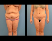 Abdominoplasty-1