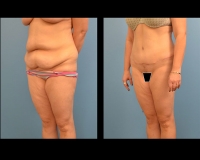 Abdominoplasty-2