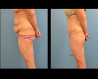 Abdominoplasty-3