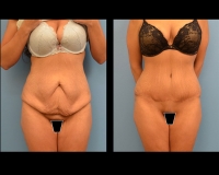 Abdominoplasty-4