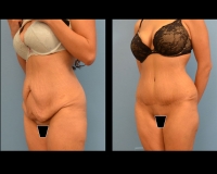 Abdominoplasty-5