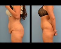 Abdominoplasty-6