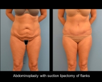 Abdominoplasty10