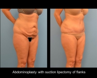 Abdominoplasty11