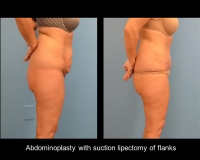 Abdominoplasty12