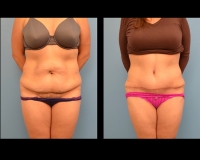 Abdominoplasty13