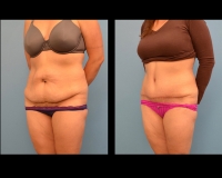 Abdominoplasty14