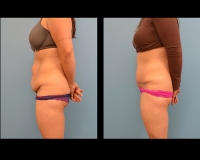 Abdominoplasty15