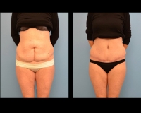 Abdominoplasty35a