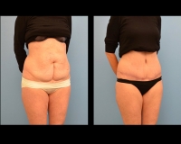 Abdominoplasty35b