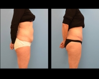 Abdominoplasty35c