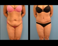 Abdominoplasty7