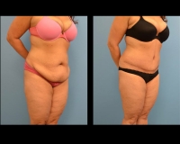 Abdominoplasty8