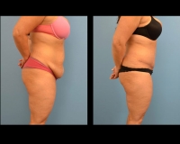 Abdominoplasty9