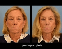 Blepharoplasty10