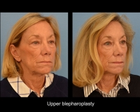 Blepharoplasty11