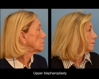 Blepharoplasty12