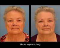 Blepharoplasty13