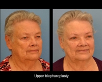 Blepharoplasty14