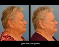 Blepharoplasty15