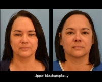 Blepharoplasty4