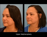 Blepharoplasty5