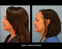 Blepharoplasty6