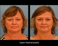 Blepharoplasty7