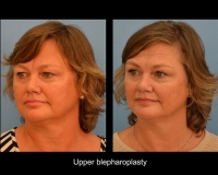 Blepharoplasty8