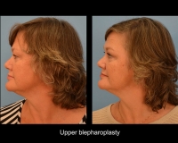 Blepharoplasty9