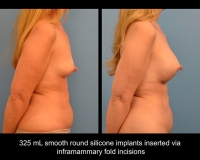 breast-augmentation1
