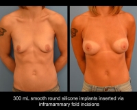 breast-augmentation10