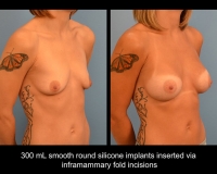 breast-augmentation11