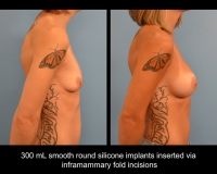 breast-augmentation12