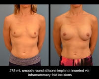 breast-augmentation13