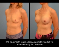 breast-augmentation14