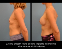 breast-augmentation15