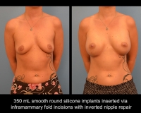 breast-augmentation16