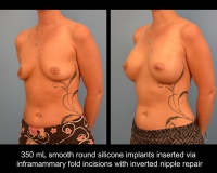 breast-augmentation17