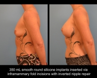 breast-augmentation18