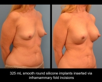 breast-augmentation2