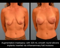 breast-augmentation21