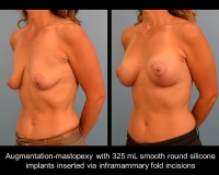 breast-augmentation22
