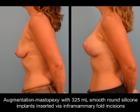 breast-augmentation23