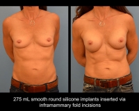 breast-augmentation24