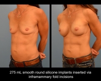 breast-augmentation25