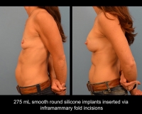 breast-augmentation26