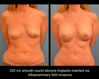 breast-augmentation3