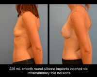 breast-augmentation4